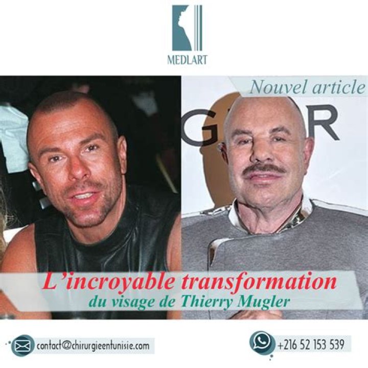 Does Manfred Thierry Mugler Had A Face Surgery? Nose Job, Accident and More