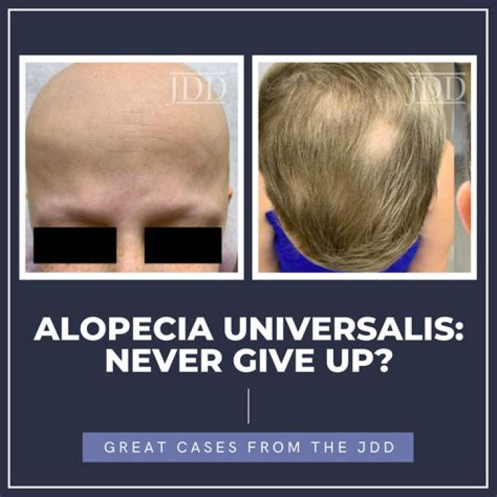Does Nicolas Roman Strut Have Cancer? Alopecia Universalis Disease & Health Condition