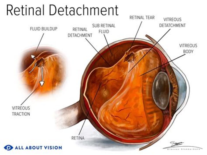What Happened To MMA Michael Bisping Eye? Detached Retina Cause Of Injury